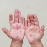 Confirman 8 casos de virus Coxsackie en escuelas de Reynosa