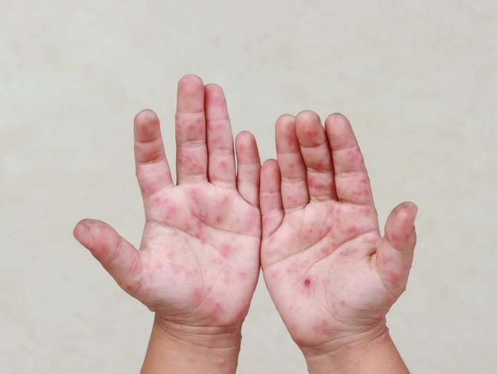 Confirman 8 casos de virus Coxsackie en escuelas de Reynosa