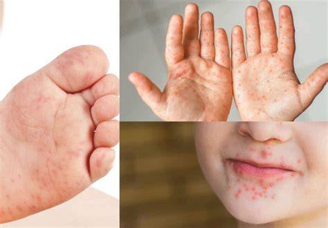 Refuerzan precauciones ante enfermedad de manos, pies y boca