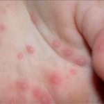 Difunde SET medidas sobre el virus boca-mano-pie entre la comunidad educativa